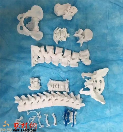3D打印人体椎骨