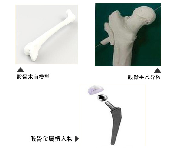 股骨金属植入物1