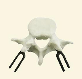 腰椎金属植入物4