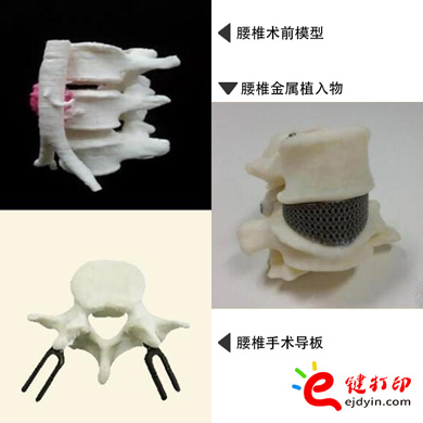 腰椎金属植入物