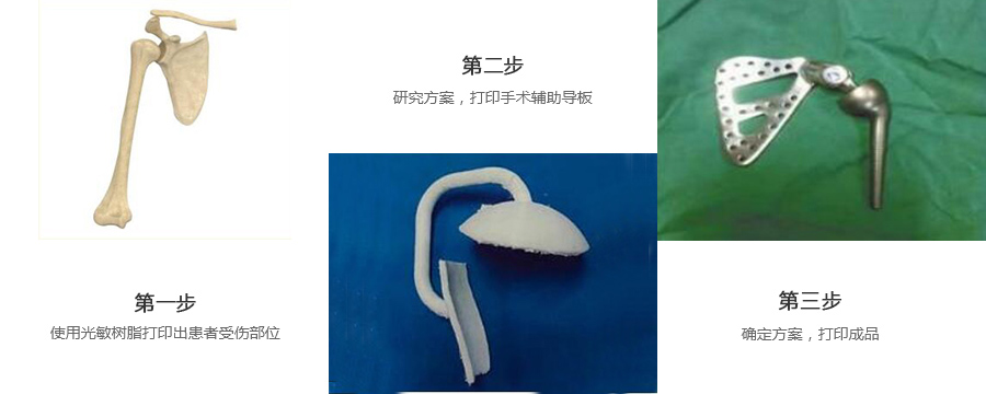 肩关节金属植入物3d打印制作流程