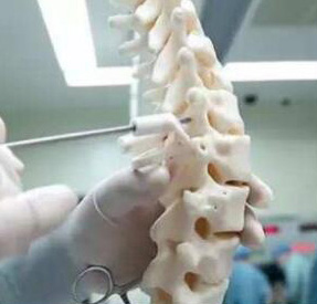 脊椎金属植入物4