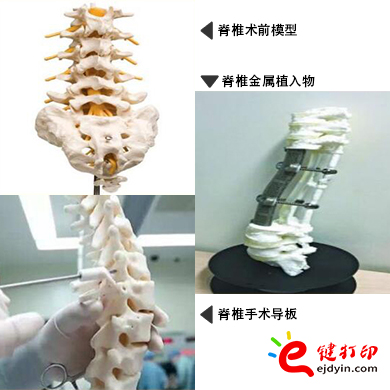 脊椎金属植入物